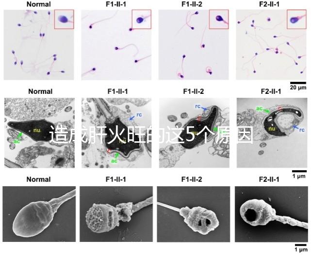 造成肝火旺的這5個(gè)原因,你都知道嗎?