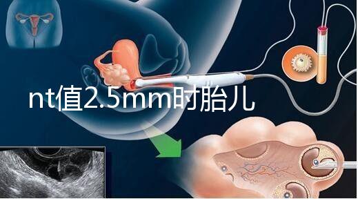 nt值2.5mm時胎兒異常幾率并不高，但羊水穿刺一定要做